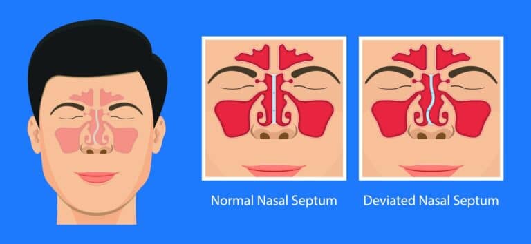 What is a Deviated Septum?